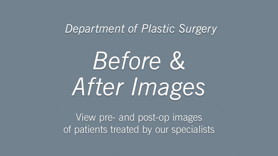 Gender Affirming Surgery Before And After Photos Cleveland Clinic
