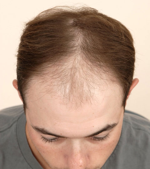 Platelet Rich Plasma (PRP) Therapy