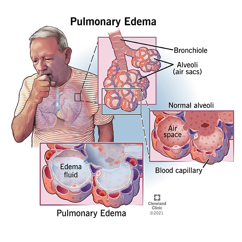 Pulmonary Edema Causes Symptoms Treatment Pulmonary Edema Sexiezpicz