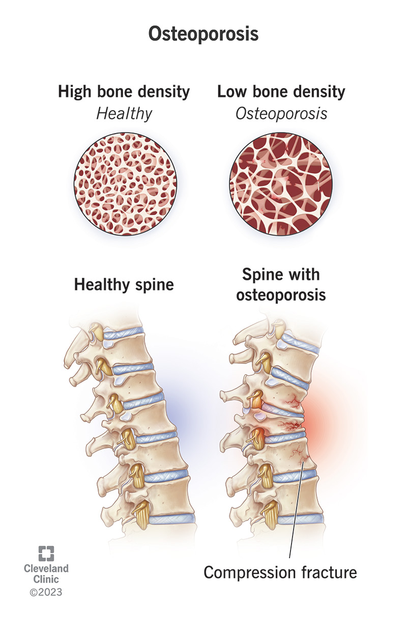 Osteoporosis Symptoms Causes And Treatment