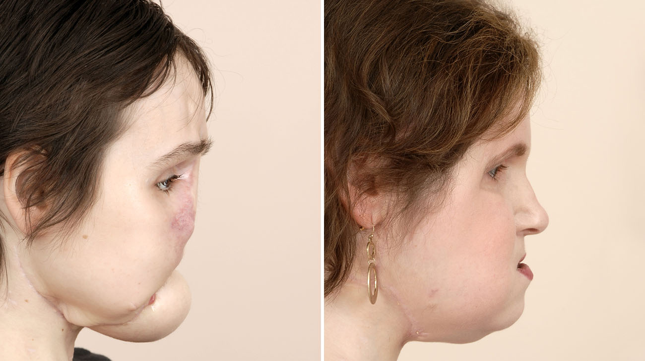  Katie Stubblefield before her face transplant in March 2015 and after in August 2018. (Courtesy: Cleveland Clinic)