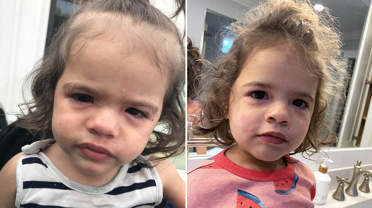 Harper had an allergic reaction to peanuts when she was 18 months old. 
