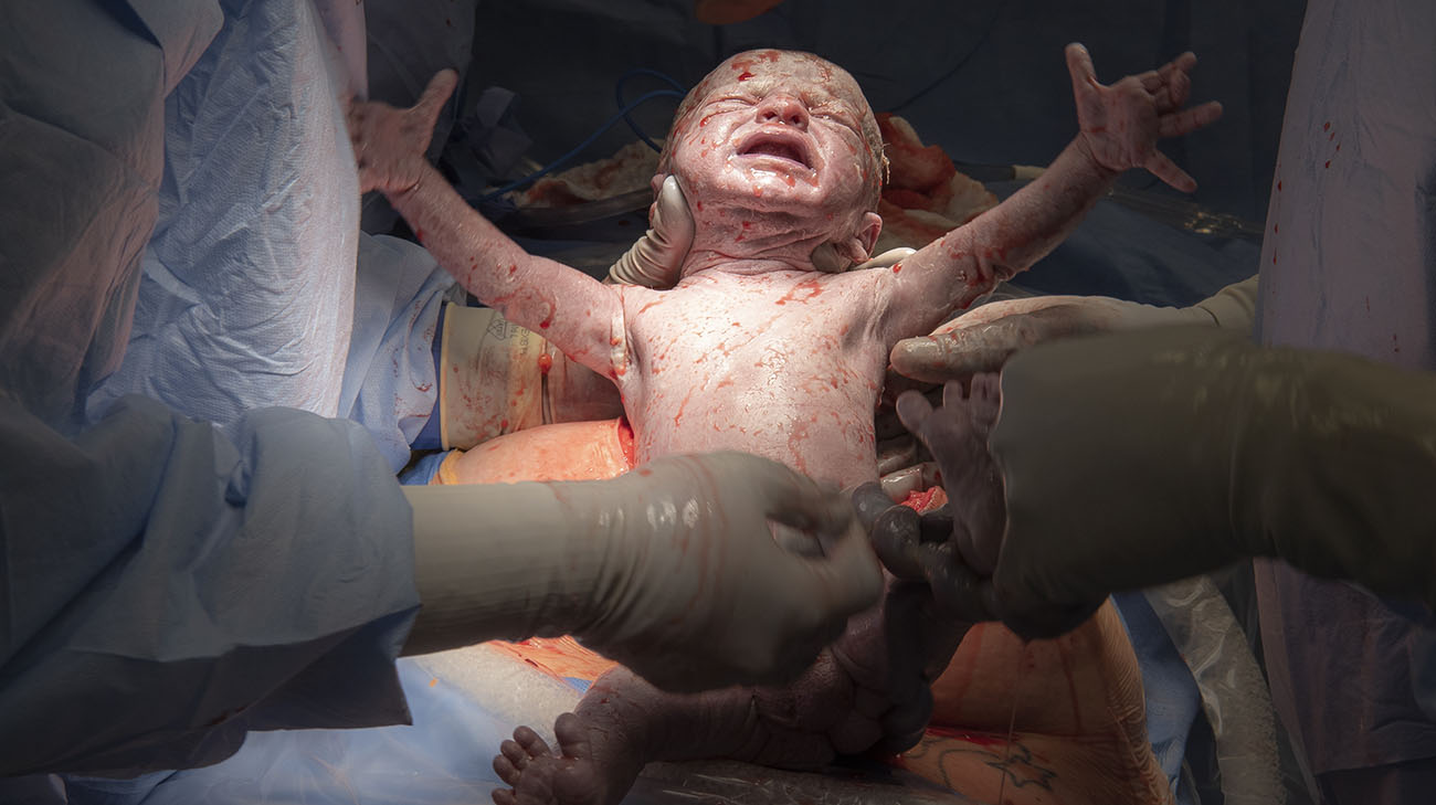 Born Without a Uterus, Woman Gives Birth After Uterus Transplant