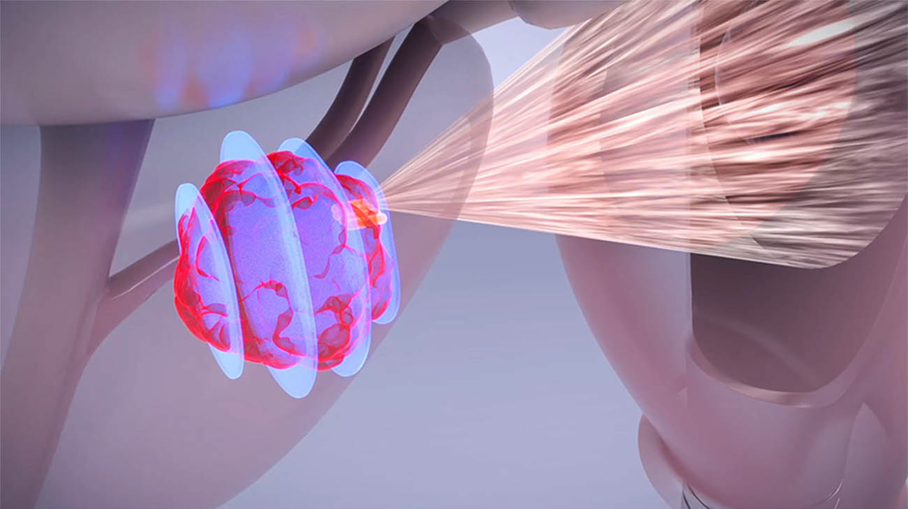 Man Benefits from Focused Ultrasound Therapy for Prostate Cancer