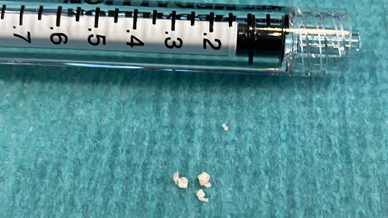 Calcifications removed from Neil Freeman's right middle cerebral artery.
