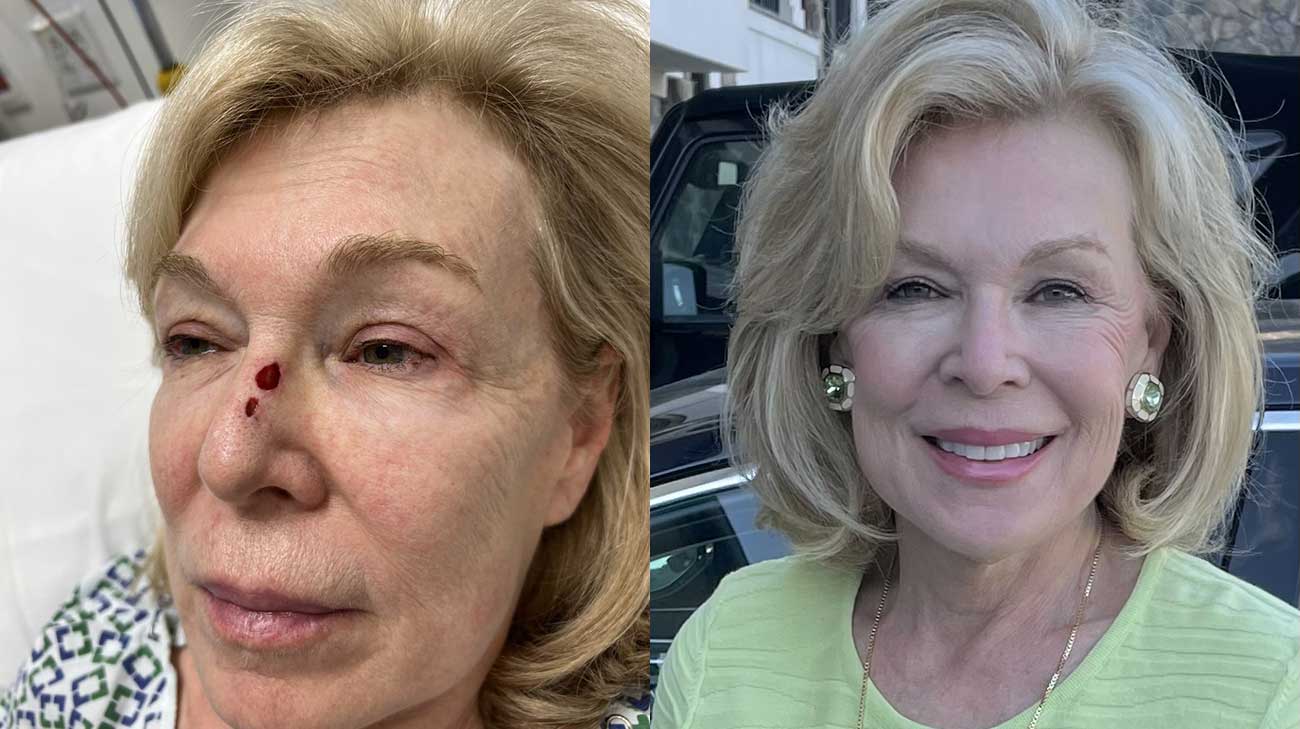 Anita before (left) nose reconstrction and after (right) Mohs procedure and nose reconstruction.