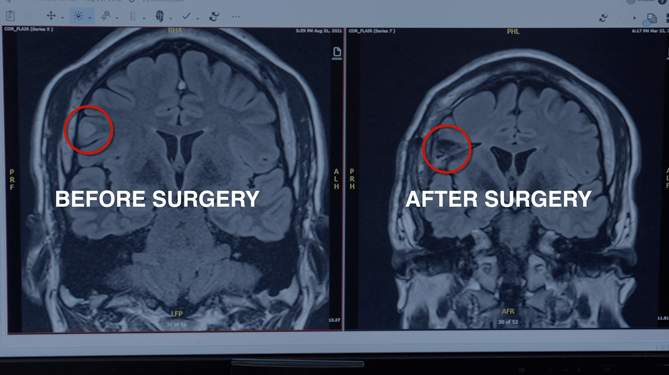 CT scans before and after epilepsy surgery of Jorge Morales' brain.