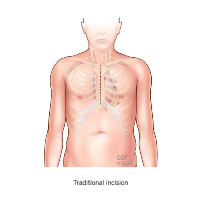 Heart Valve Surgery Techniques Traditional Incision