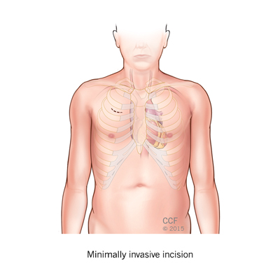 Heart Valve Surgery Techniques Minimally Invasive Incision