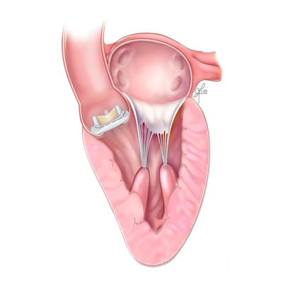 Heart Valve Surgery Replacement