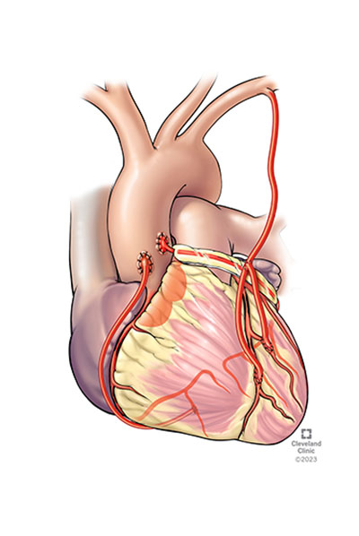 Coronary Artery Disease Surgery