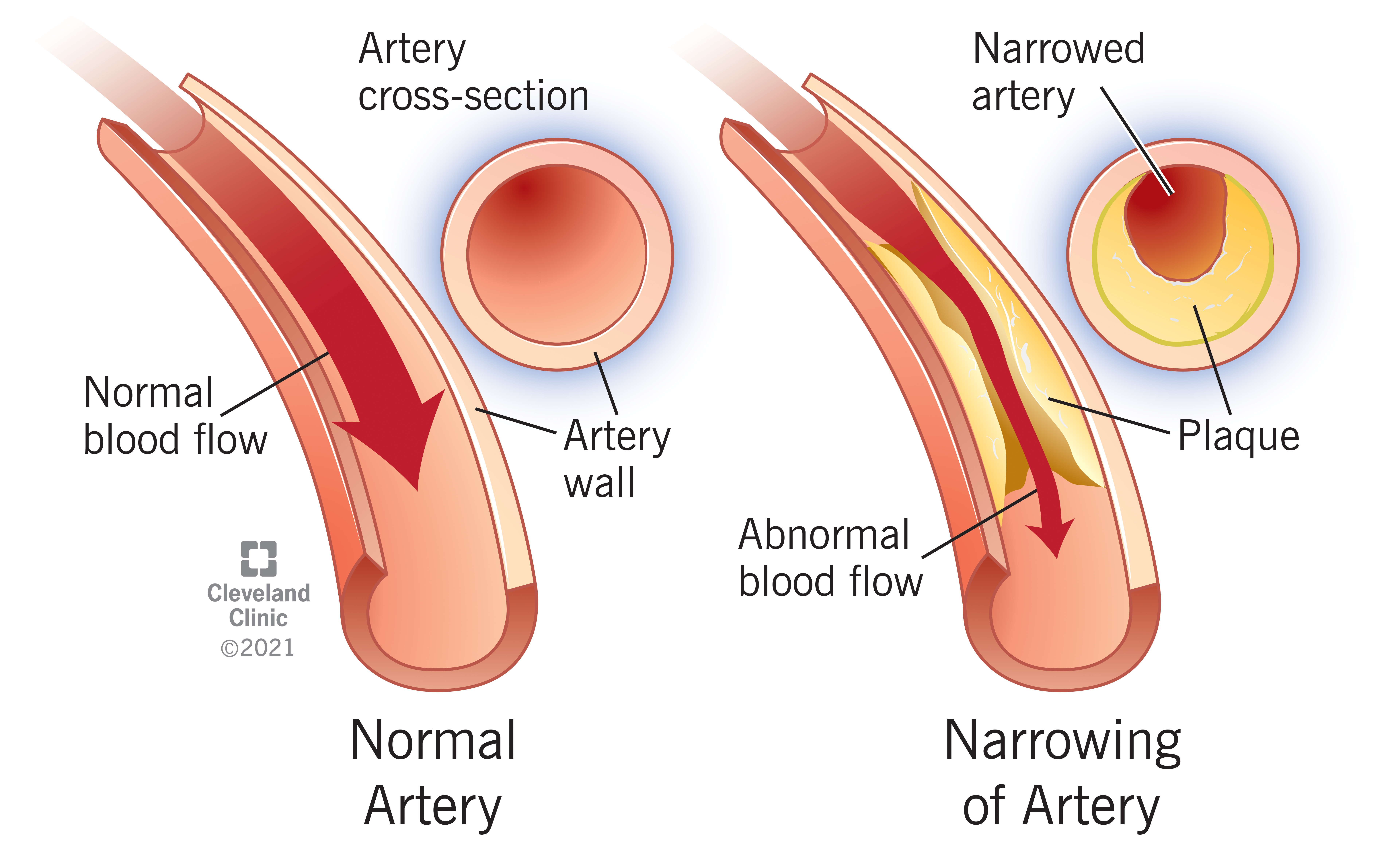Normal vs. Stenosis Artery