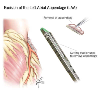 Excision of the Left Atrial Appendage