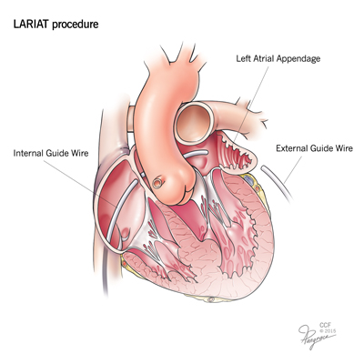 AFIB Lariat Procedure