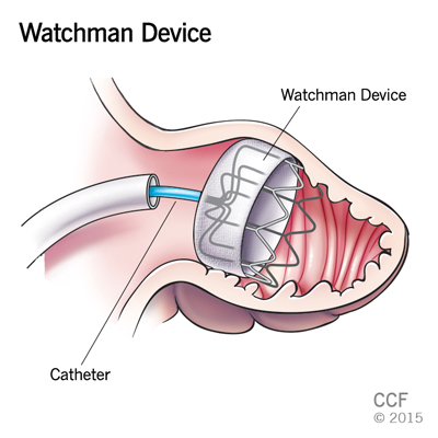 Watchmen Device for AFIB