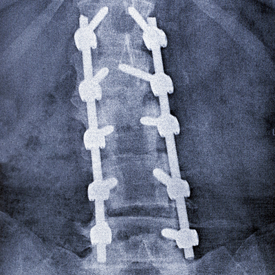 Scoliosis Treatment Guide | Cleveland Clinic