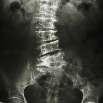 Scoliosis Treatment Guide | Cleveland Clinic