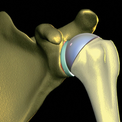 Joint Replacement For Shoulder Pain