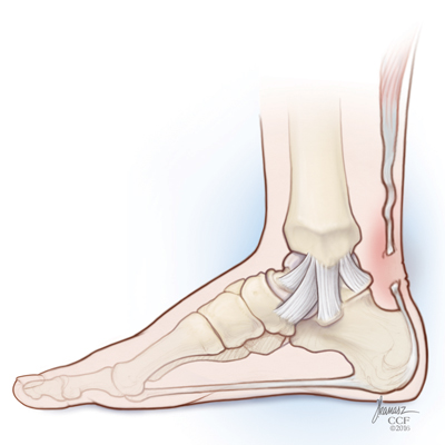 Foot and Ankle Pain: Achilles Tear