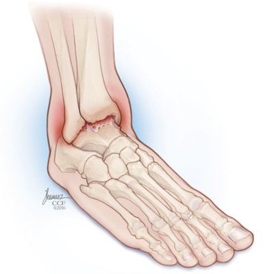Foot and Ankle Pain: Ankle Arthritis