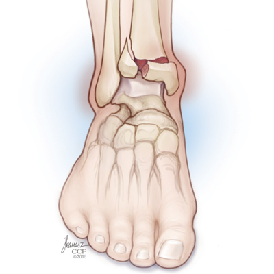 Foot and Ankle Pain: Fracture Signs