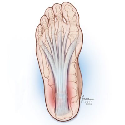 Foot and Ankle Pain: Plantar Fasciitis