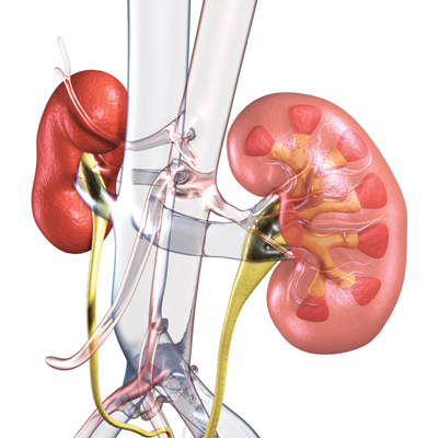 Kidney Stones Causes