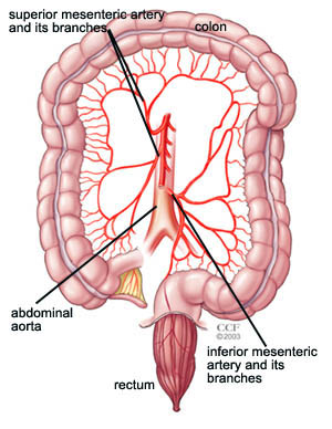 Intestinal Ischemic Syndrome