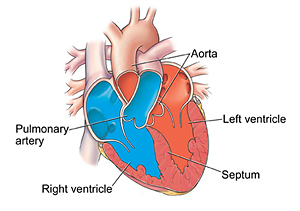 Tetralogy of Fallot in Adults: Treatment & Risks