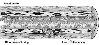 Microscopic Polyangitis Illustration