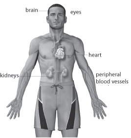 Illustration of Brain, Eyes, Heart, Kidneys, Peripheral Blood Vessels