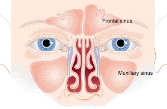 Sinusitis acute Acute maxillary