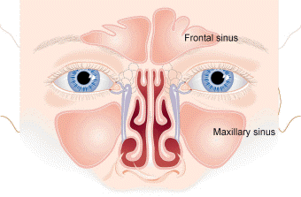 severe sinus infection