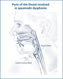 Spasmodic Dysphonia: Types, Causes, Management