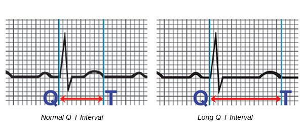 Long Q T Syndrome Lqts Causes Symptoms Management