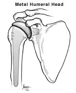 An illustration of the metal humeral head in the shoulder.