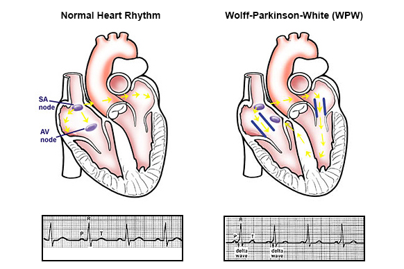 Syndrome de Wolff-Parkinson-White (WPW)