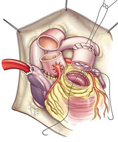 Ein pulmonales Homotransplantat wird am Ausflusstrakt des rechten Ventrikels angebracht.