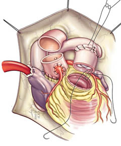 Sağ ventrikül çıkış yoluna bir pulmoner homogreft yapıştırılır.