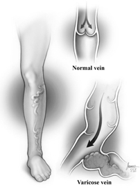 Tratamentul venelor varicoase în zelenograd Varicoza picioare umflaturi dupa natere