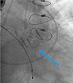 Transcatheter Aortic Valve Replacement (TAVR) | Cleveland Clinic