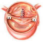 Réparation de la valve aortique bicuspide