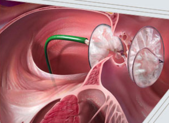 Occulteur septal GORE HELEX® - Cleveland Clinic