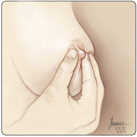 breast self-exam, nipple squeeze self-exam