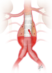 Endoleak Type 3 due to tear in graft