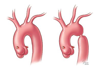 Coarctation Of The Aorta Symptoms Treatments Tests