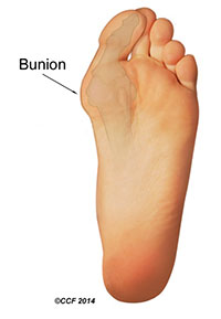 Ilustrasi Kaki: Bunion