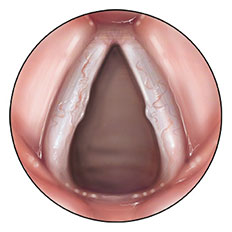 vocal cord lesion
