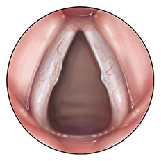 lesión de las cuerdas vocales