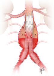 Endoleak - Type IV due to blood passing through the fabric of the graft into the sac